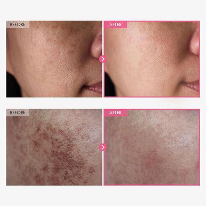 TOSOWOONG Arbutin – Dark Spots, Acne Marks & Uneven Skin | 50ml